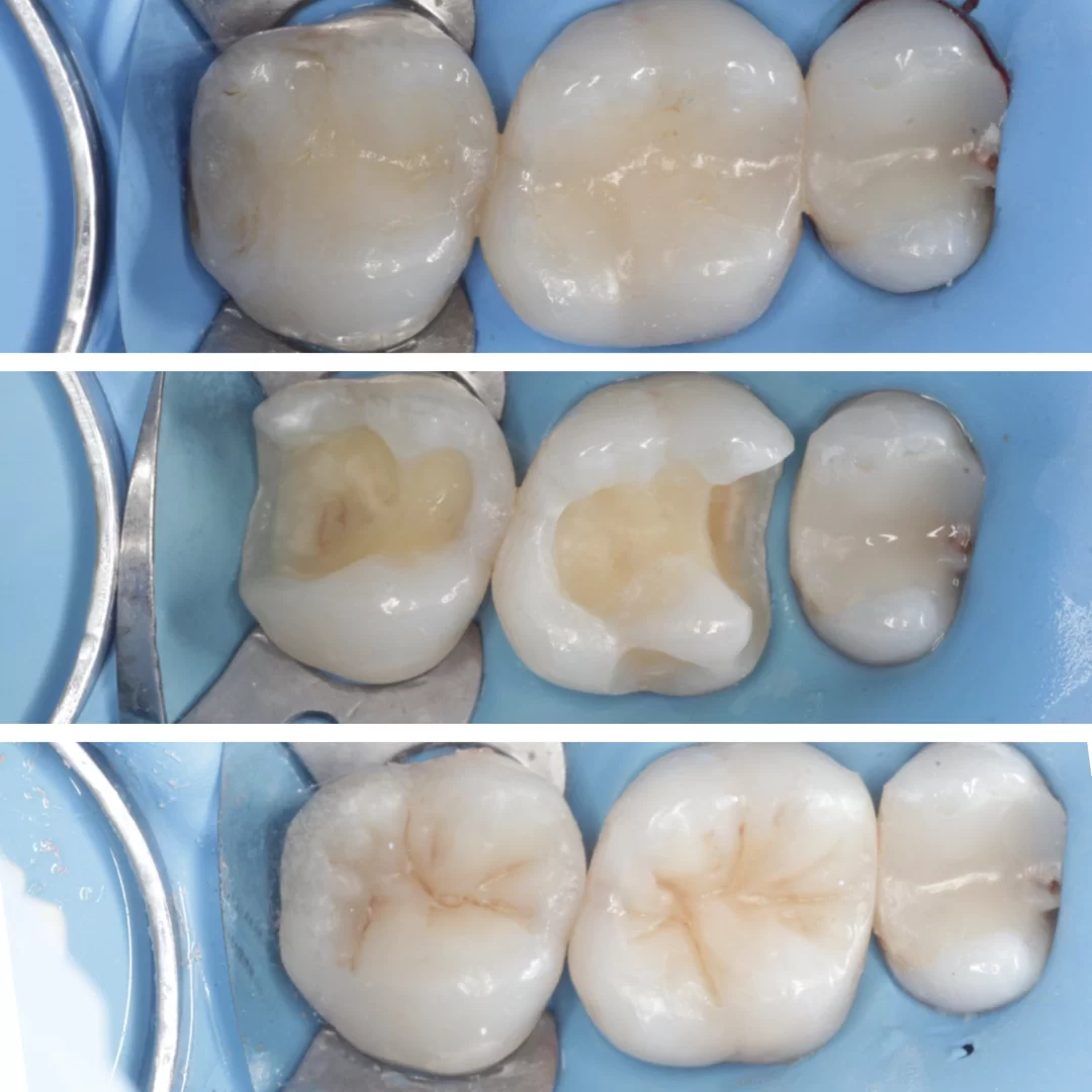 Реставрация боковых Зубов